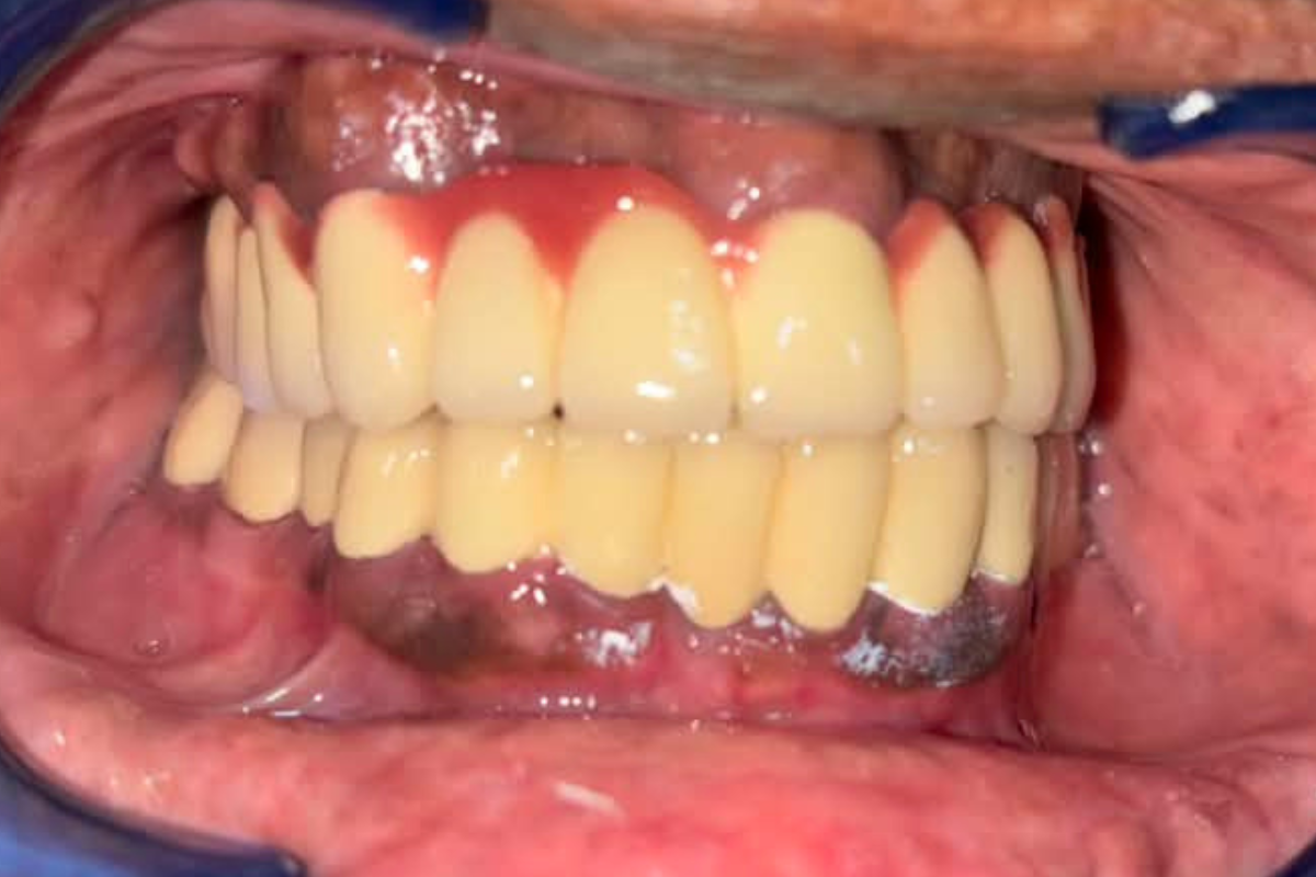 After Treatment